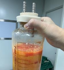 长垣水动力吸脂手术要做多久？